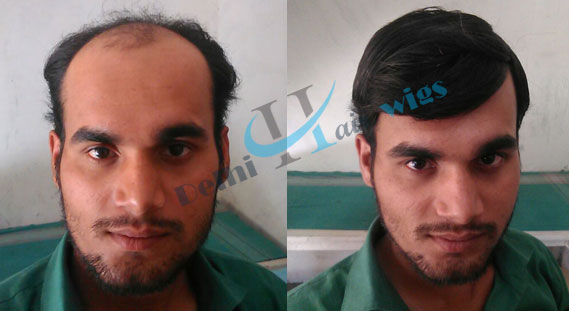 Delhi Hair Wigs - Before & After Gallery Delhi Hair Wigs - Before & After Gallery
